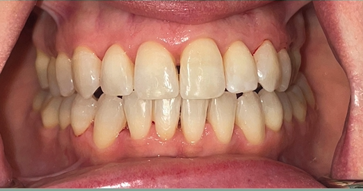 After treatment