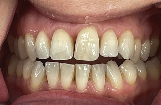 Before treatment